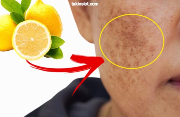 remove dark spots lemon juice